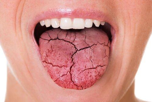 Close-up of a person’s mouth with a severely dry and cracked tongue, illustrating symptoms of dry mouth or xerostomia