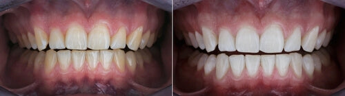 laserglow teeth whitening before and after