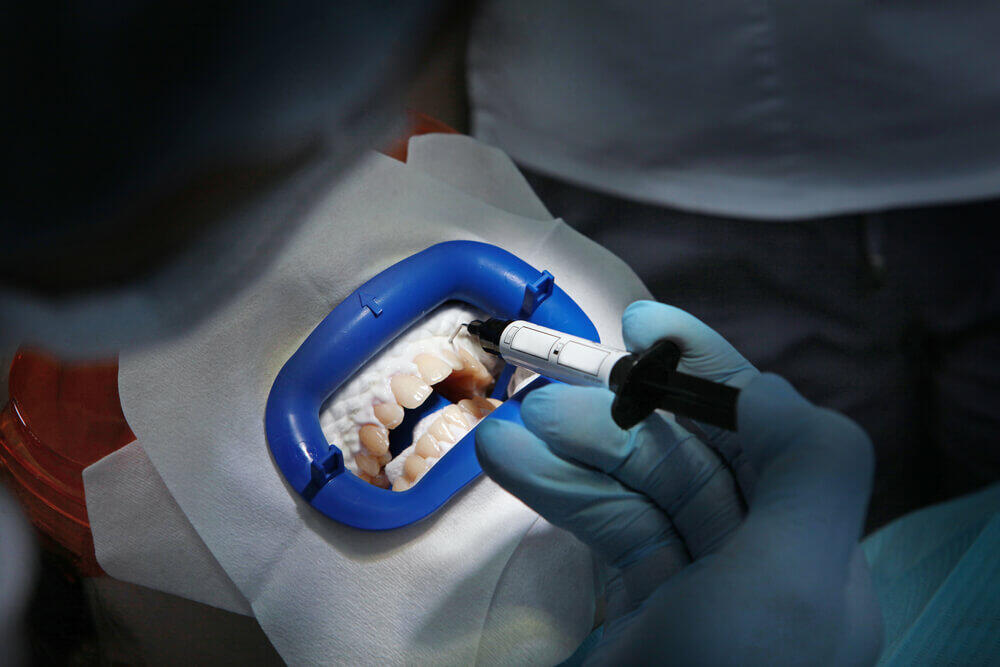 LaserGlow 38% Hydrogen Peroxide Whitening Gel in a dual barrel design for precise application and brighter, whiter smiles.