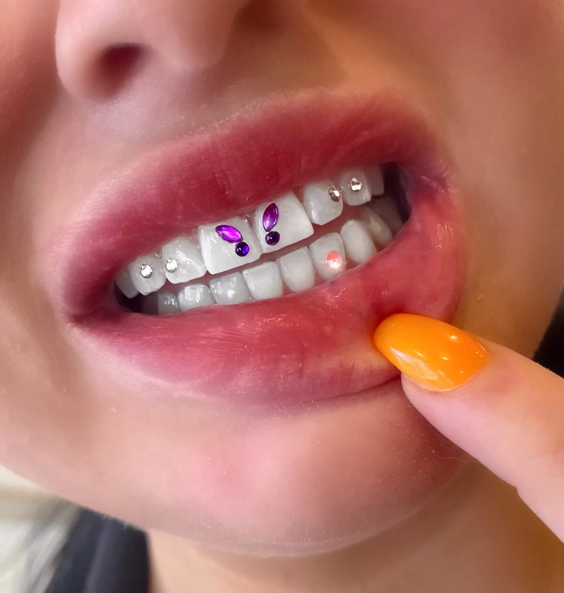 Butterfly tooth gem crystals in purple color on canine tooth