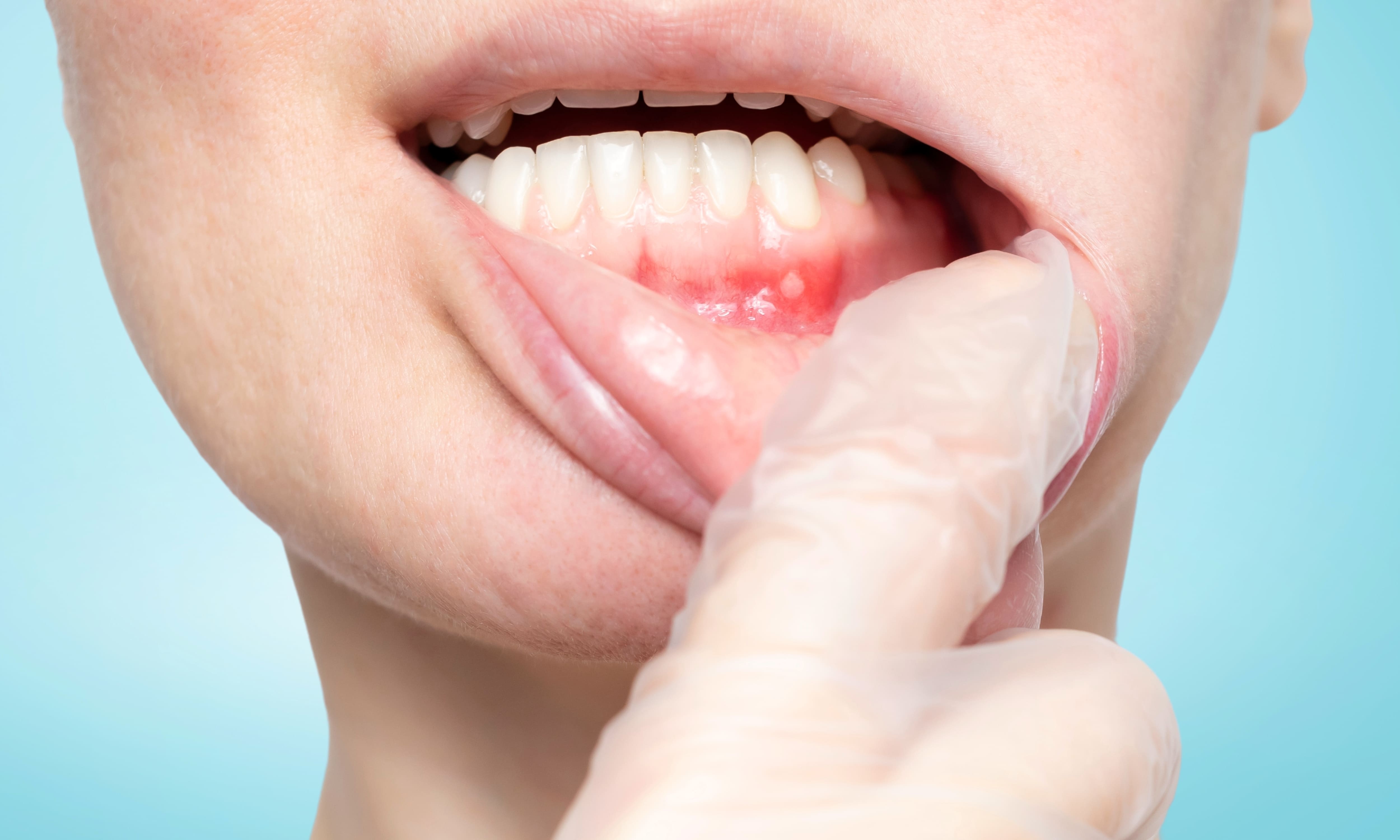 The Laserglow cold sore red light therapy device highlighted against a neutral background, emphasizing its effectiveness in treating cold sores and oral lesions