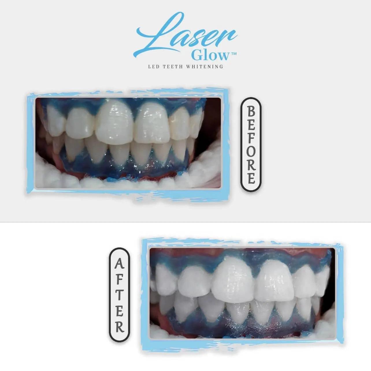 LaserGlow’s dentist-tested 44% hydrogen peroxide teeth whitening gel, designed for professional use.