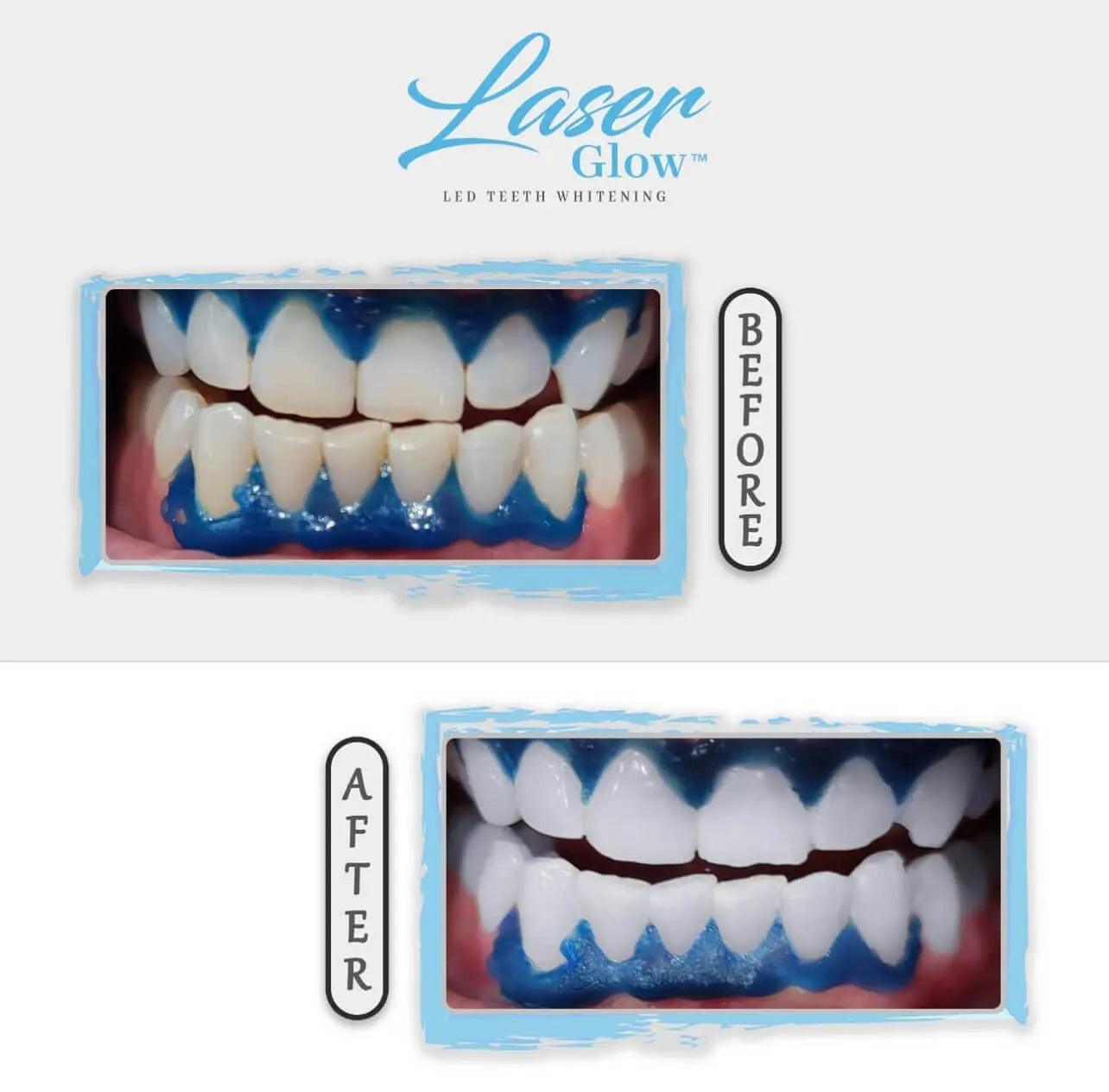 Professional-grade 44% hydrogen peroxide teeth whitening gel by LaserGlow, trusted by dental experts