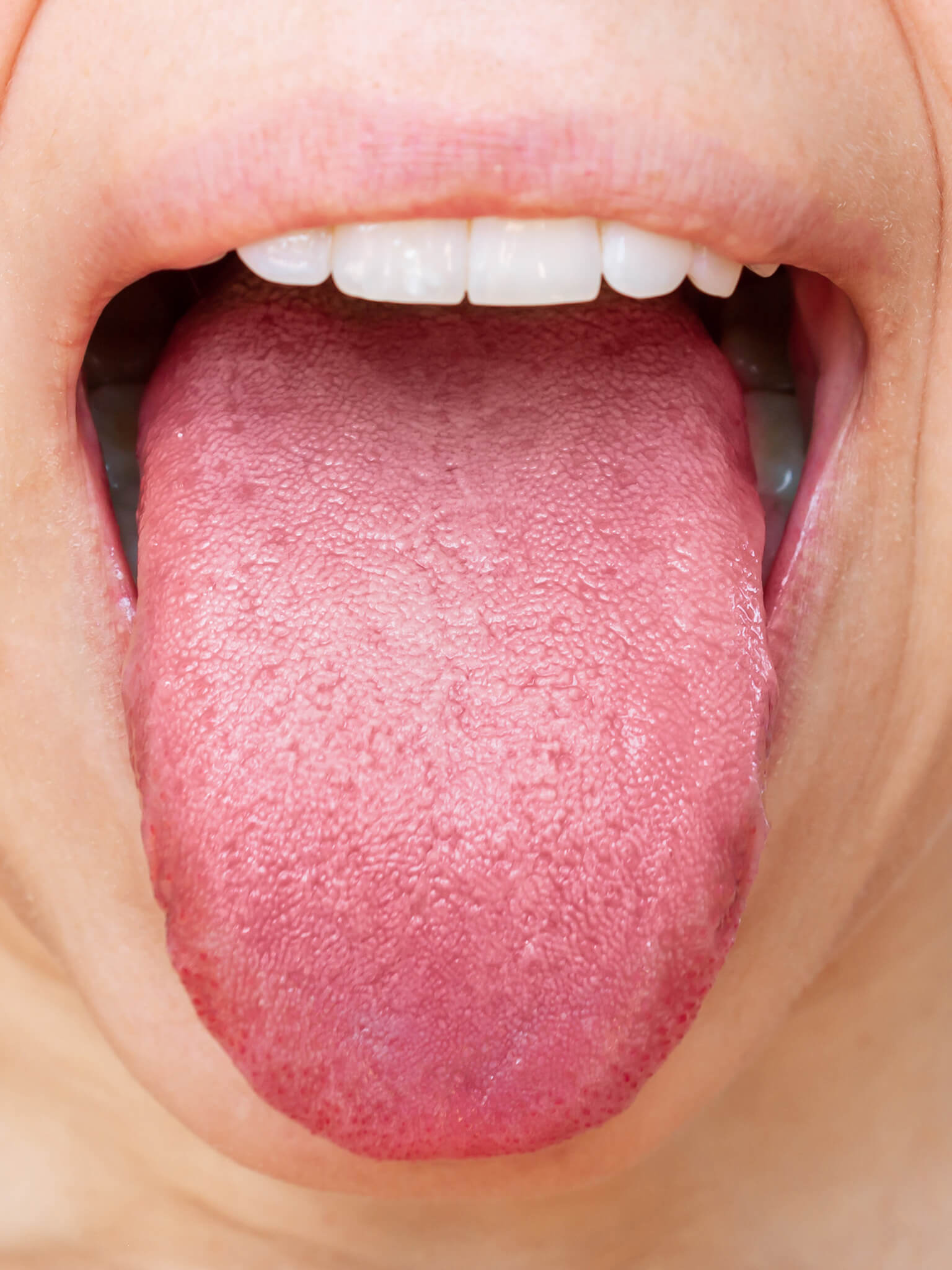 After tongue scraping – clean tongue surface showing improved oral hygiene and fresher breath