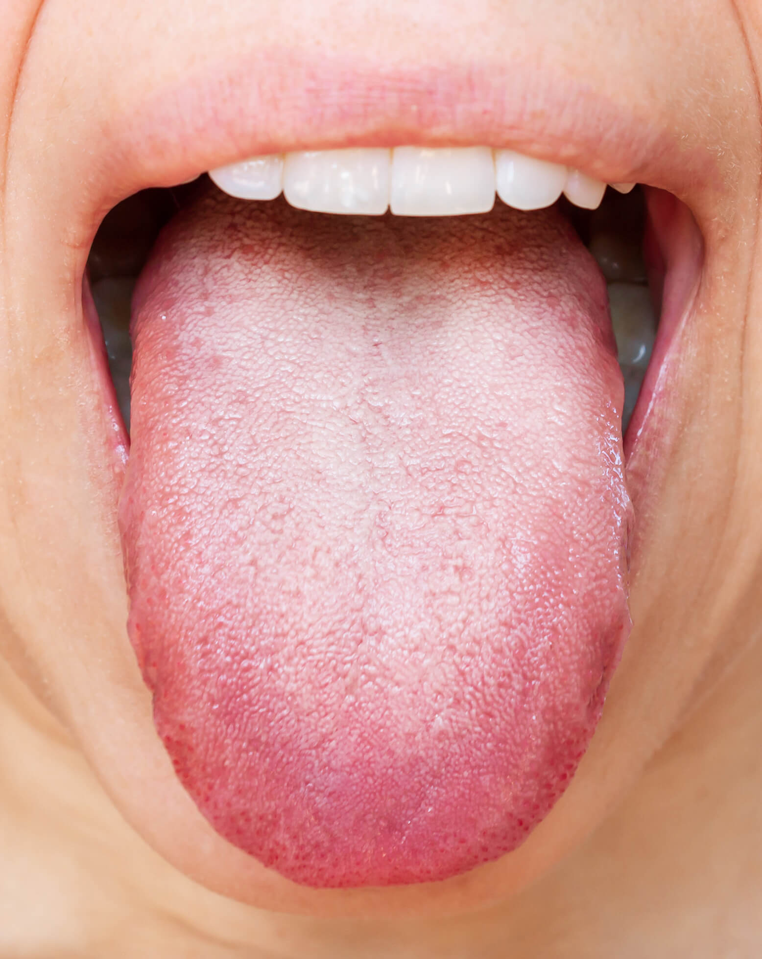 Before tongue scraping – tongue with visible buildup causing bad breath and poor oral hygiene