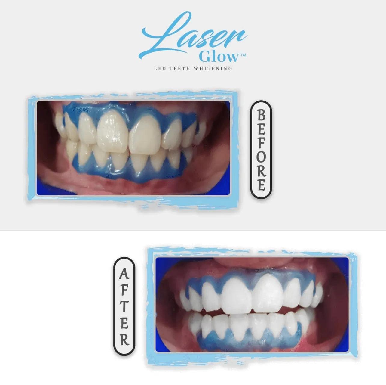 LaserGlow 44% Hydrogen Peroxide Professional Teeth Whitening Gel for safe, effective whitening.
