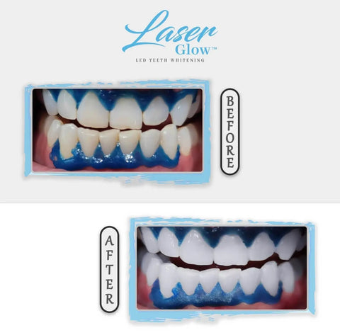 laserglow teeth whitening gel 25 hydrogen peroxide