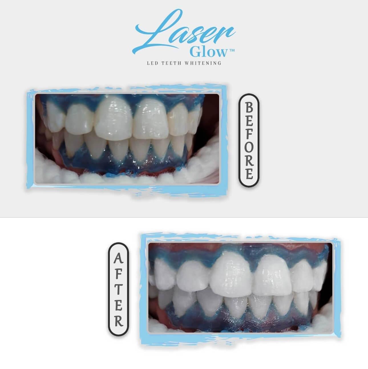 teeth whitening