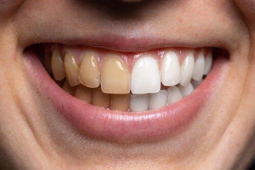 teeth stains