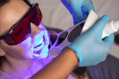 laserglow professional teeth whitening