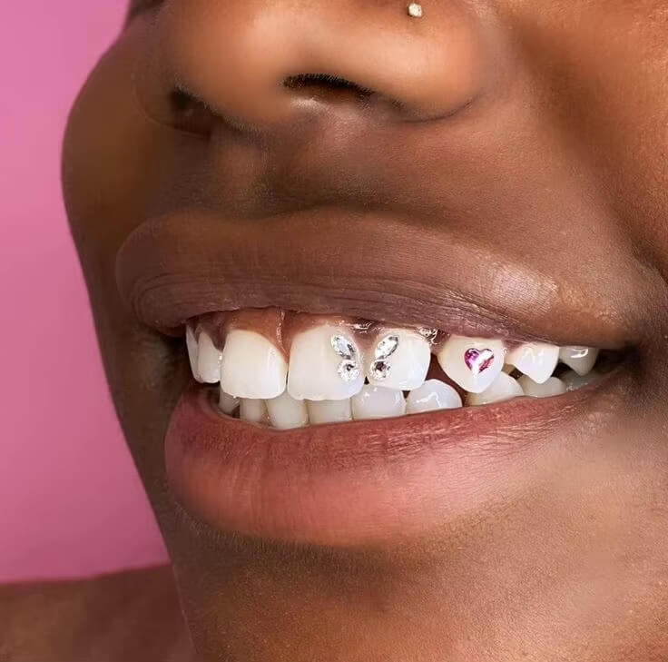 Close-up of a diamond-cut LaserGlow butterfly tooth gem sparkling on a front tooth, showcasing luxury designer tooth jewelry.