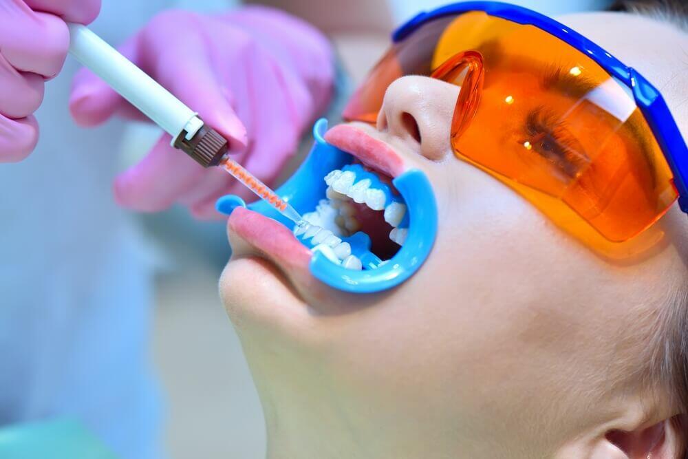 LaserGlow Dual Barrel Syringe with 44% Hydrogen Peroxide for advanced, enamel-safe whitening trusted by professionals.
