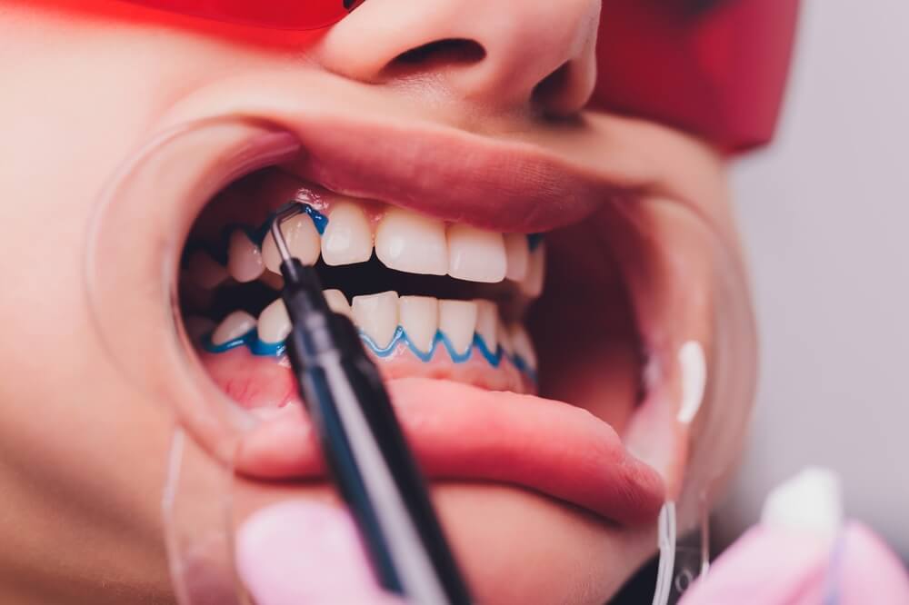 LaserGlow Gingival Barrier designed to shield gums during professional teeth whitening procedures for a safe and comfortable experience.