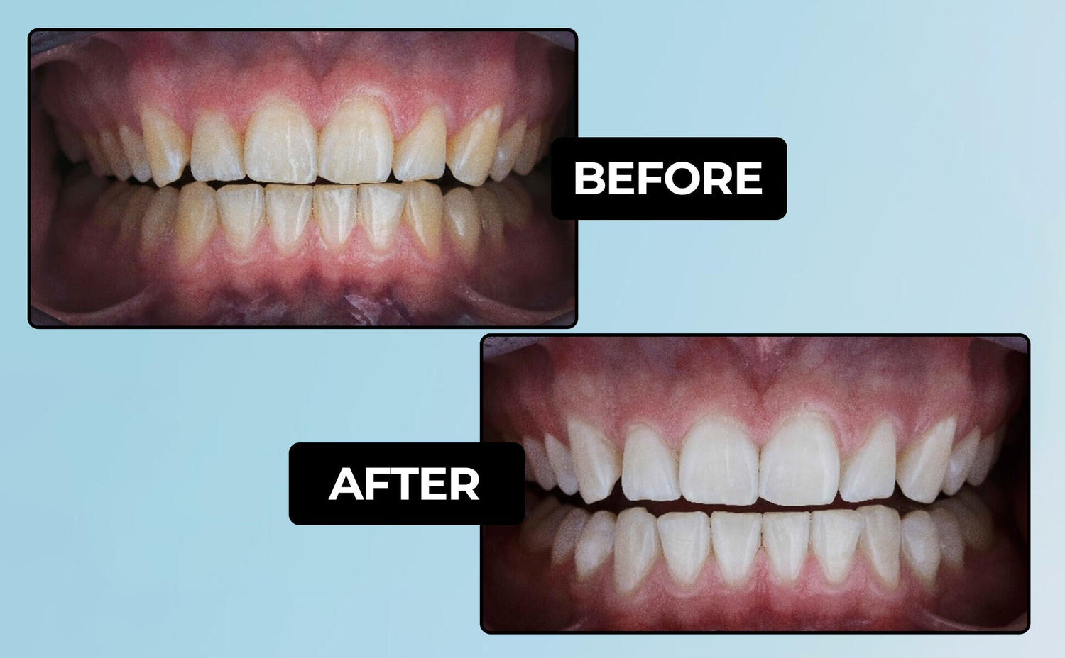 LaserGlow 44% Carbamide Peroxide Whitening Gel Pen providing professional-grade whitening.