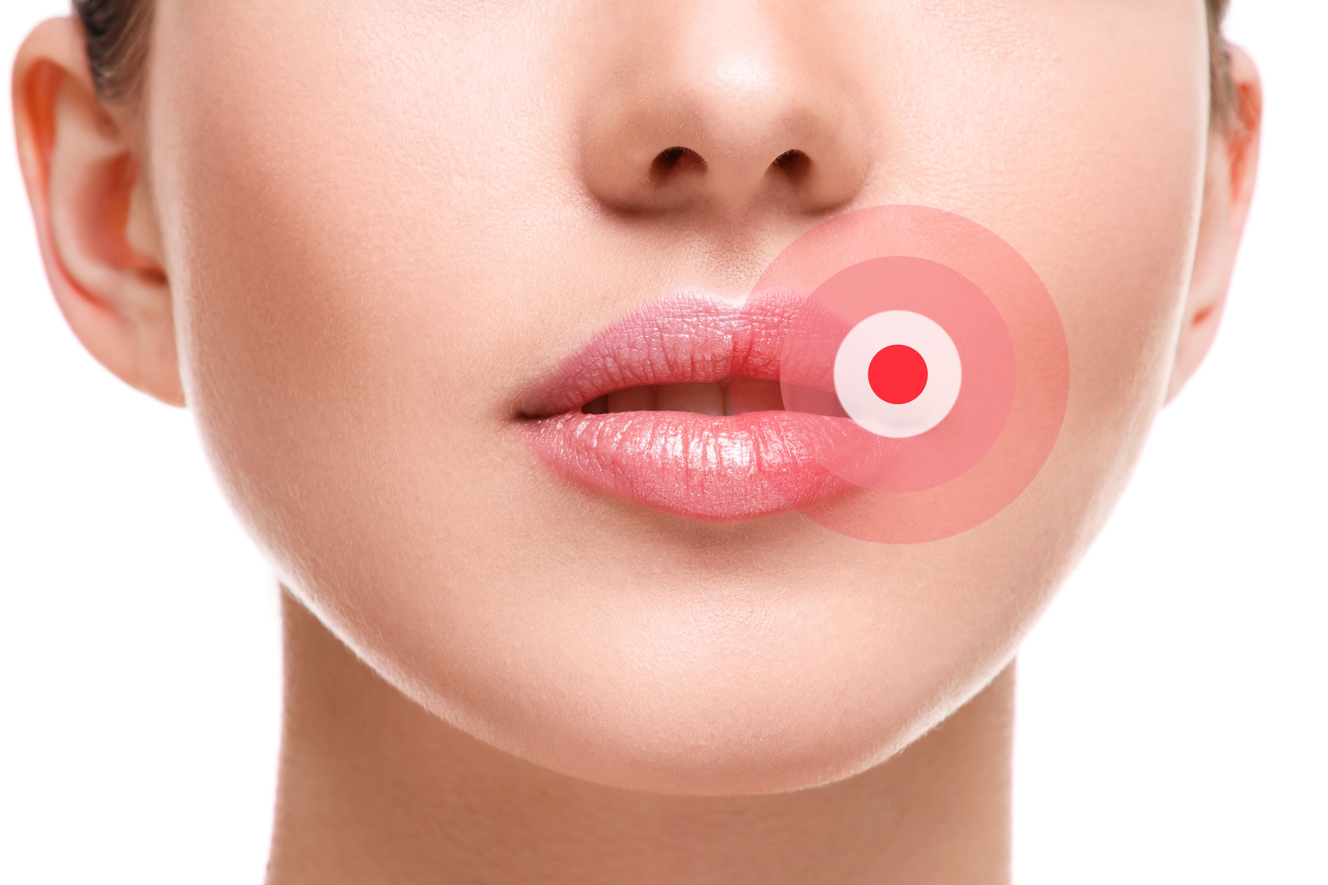 Laserglow cold sore red light therapy device designed to speed up healing of cold sores and canker sores