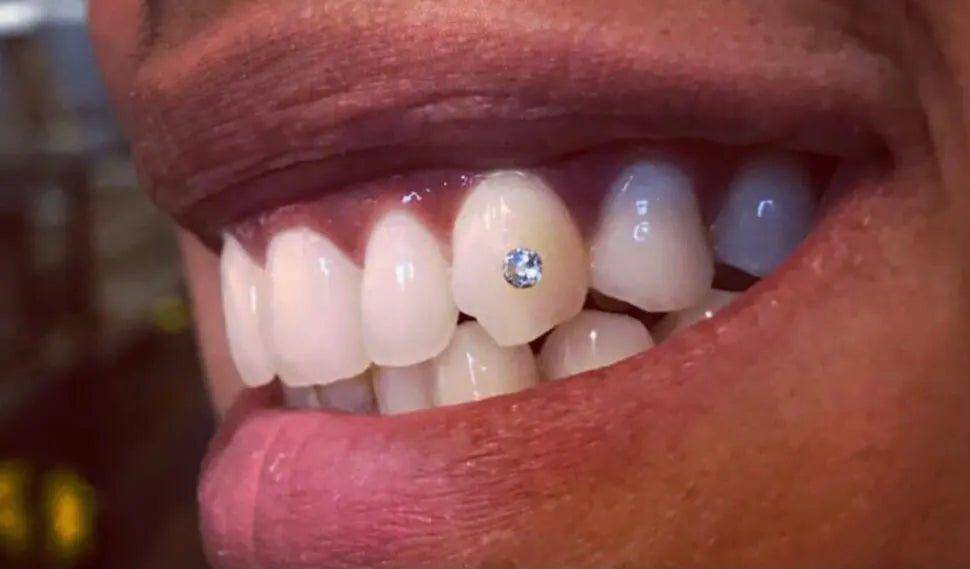 LaserGlow Swarovski Tooth Gems applied for a unique and stylish smile enhancement.