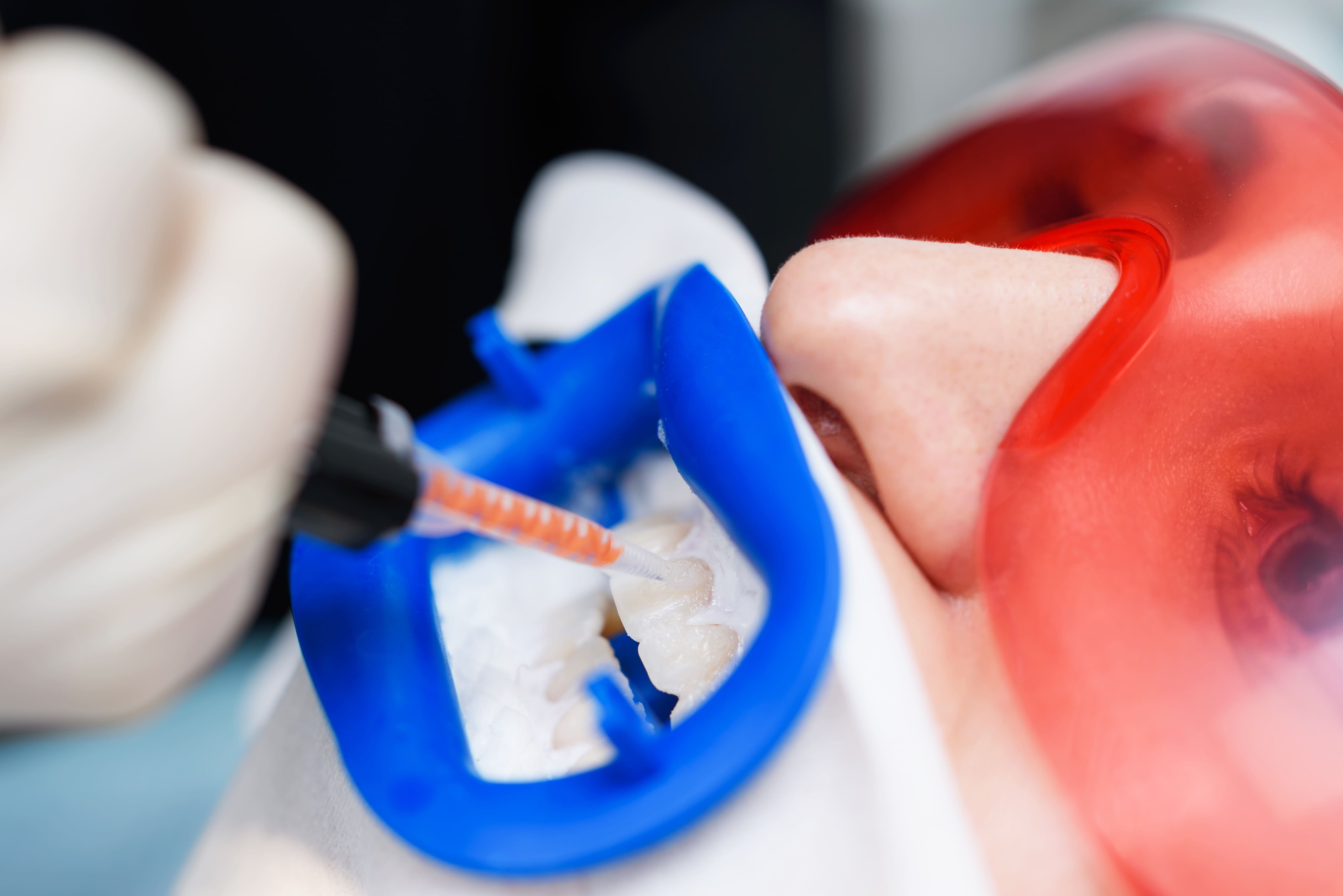 LaserGlow professional hydrogen peroxide teeth whitening gels for pro use designed for dentists, med spas, salons, and whitening professionals.