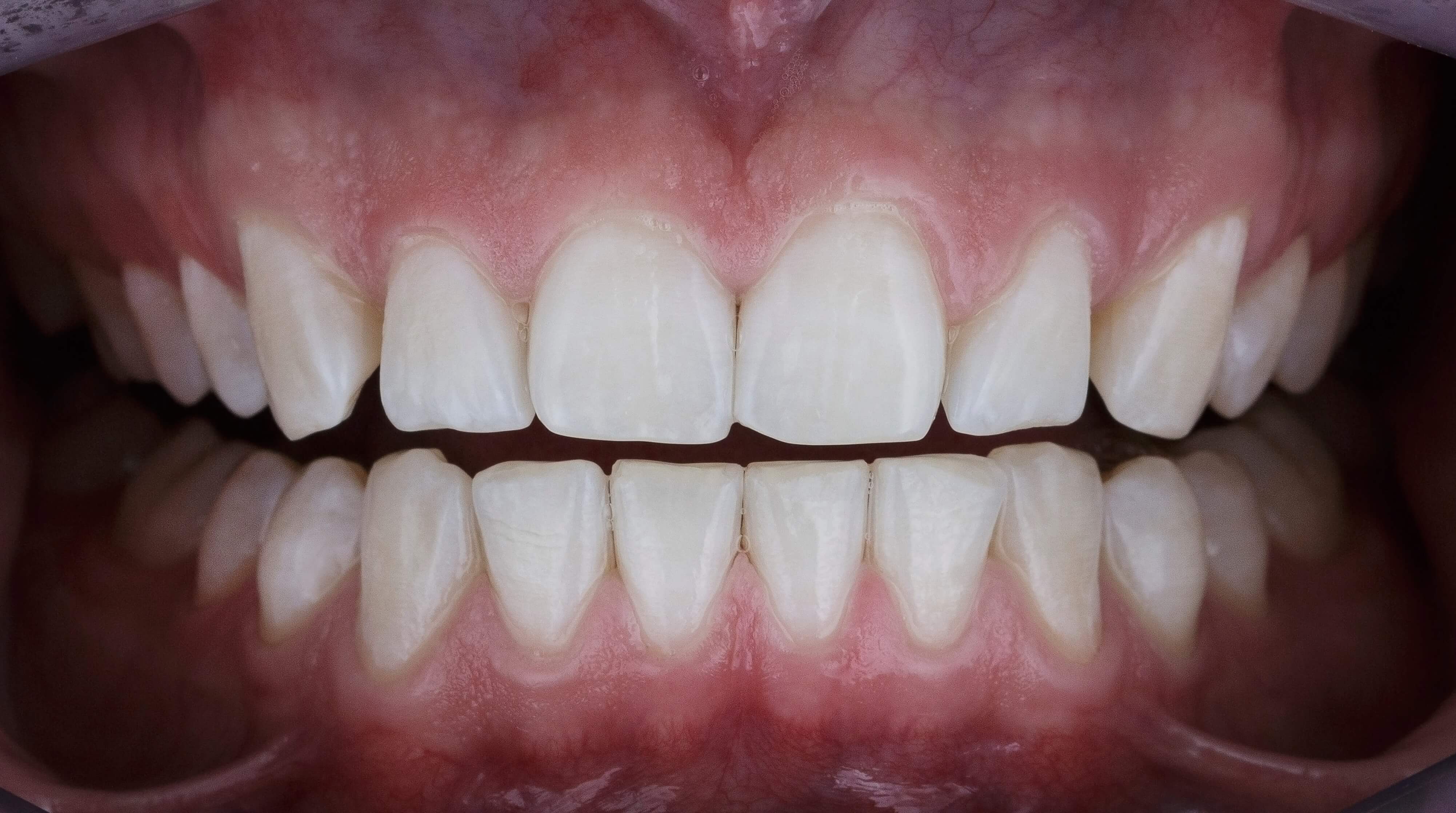 LaserGlow professional teeth whitening after treatment results showing brighter, whiter teeth following whitening session