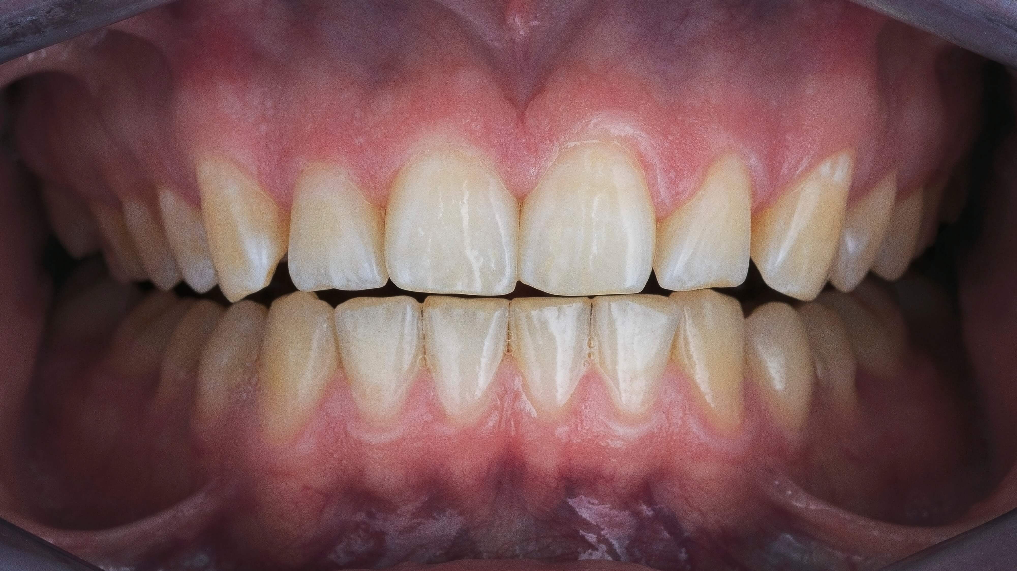LaserGlow professional teeth whitening before treatment comparison showing stained teeth prior to whitening session