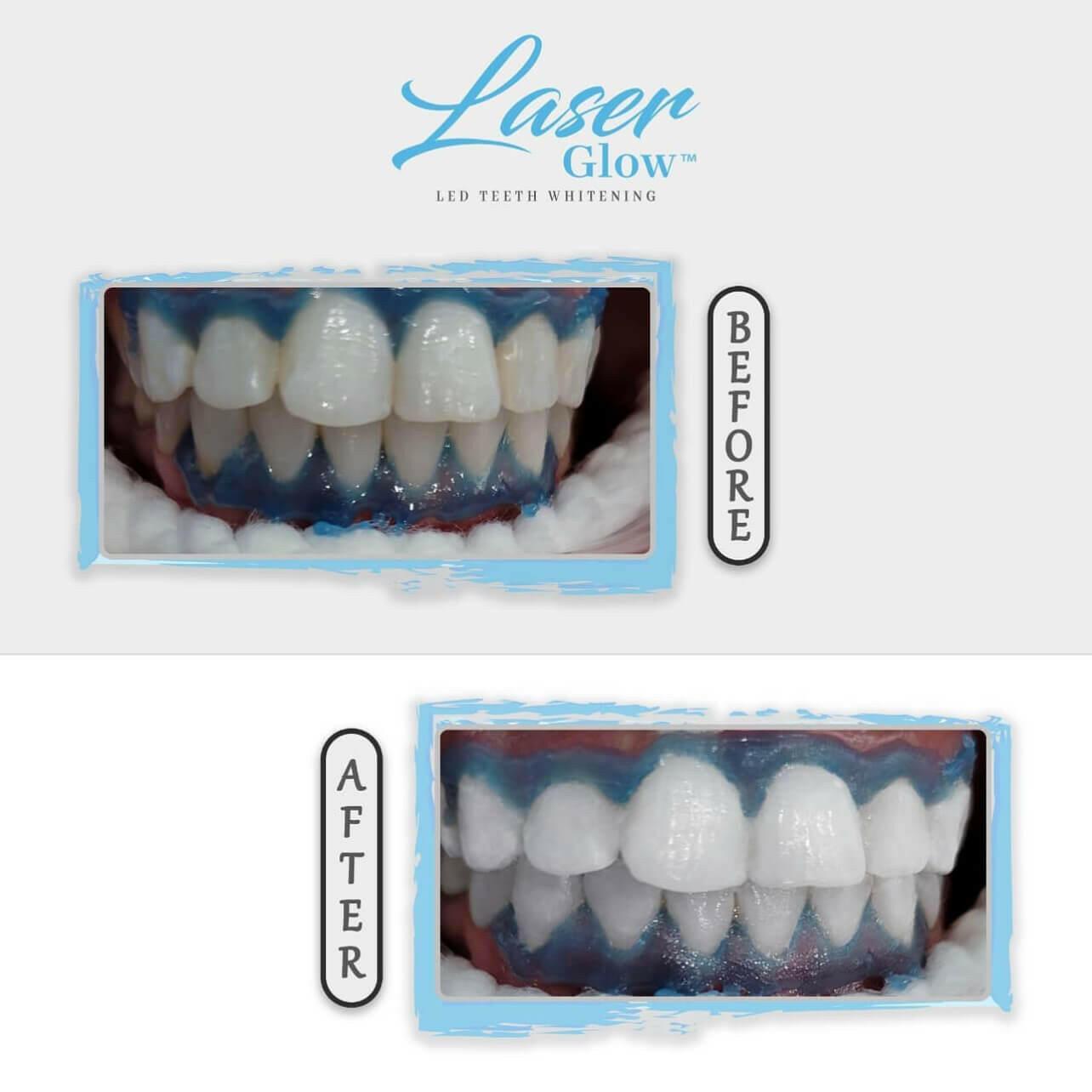 laserglow teeth whitening gum protection to avoid blanching during teeth whitening treatments.