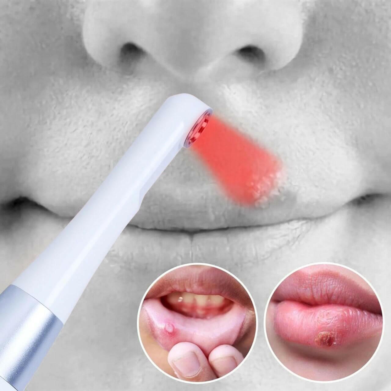 Cold sore relief with LaserGlow red light therapy for faster healing and reduced pain.