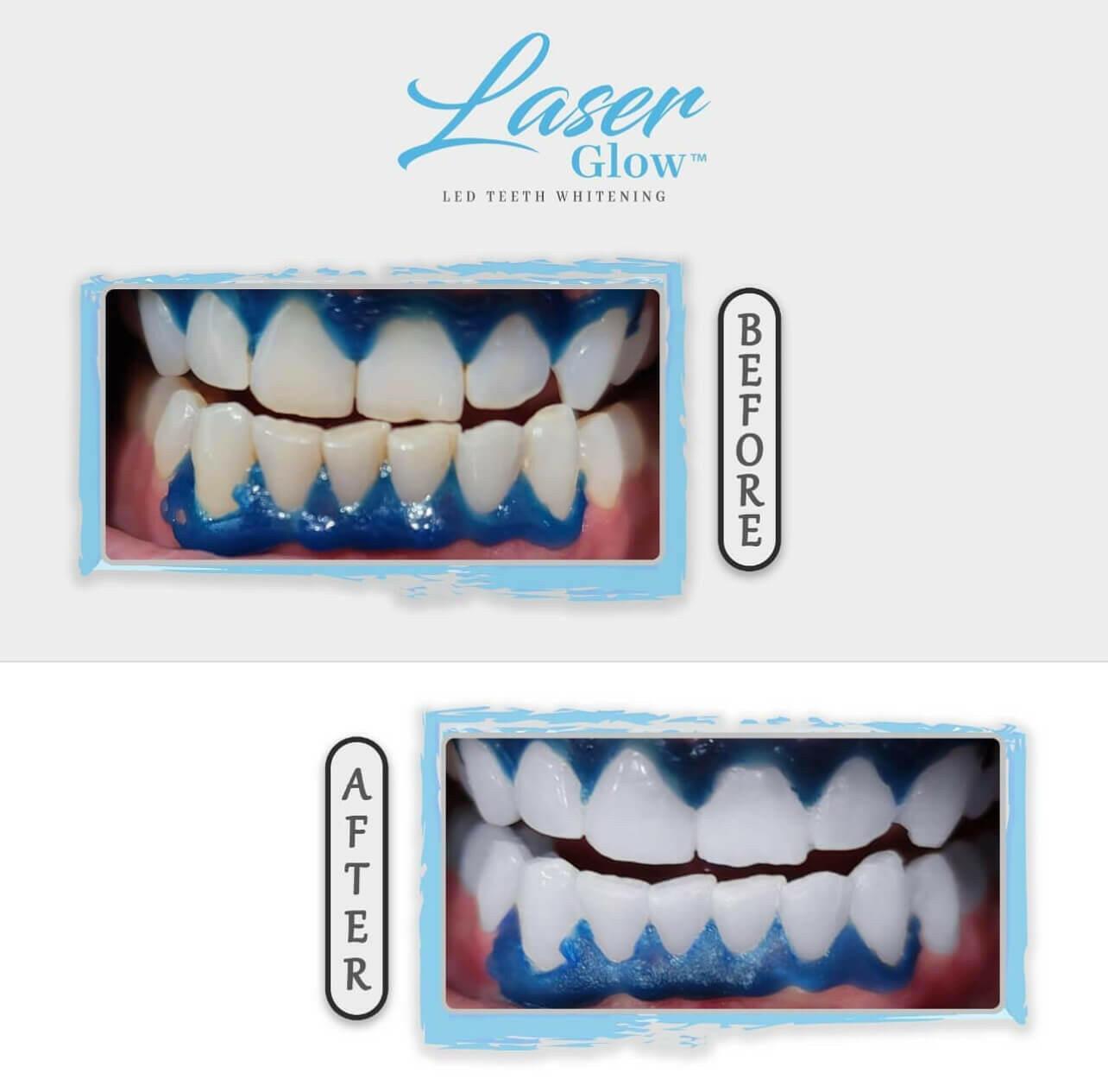 laserglow gingival barrier applicator to protect gums during teeth whitening.
