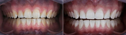 LaserGlow teeth whitening before and after: natural teeth visibly brighter after one in-office session