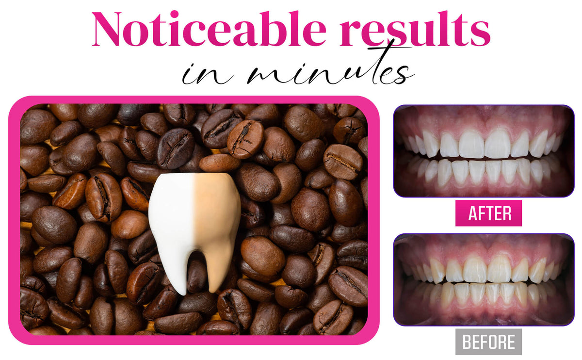 LaserGlow LED teeth whitening kit before and after results on coffee and tea stains