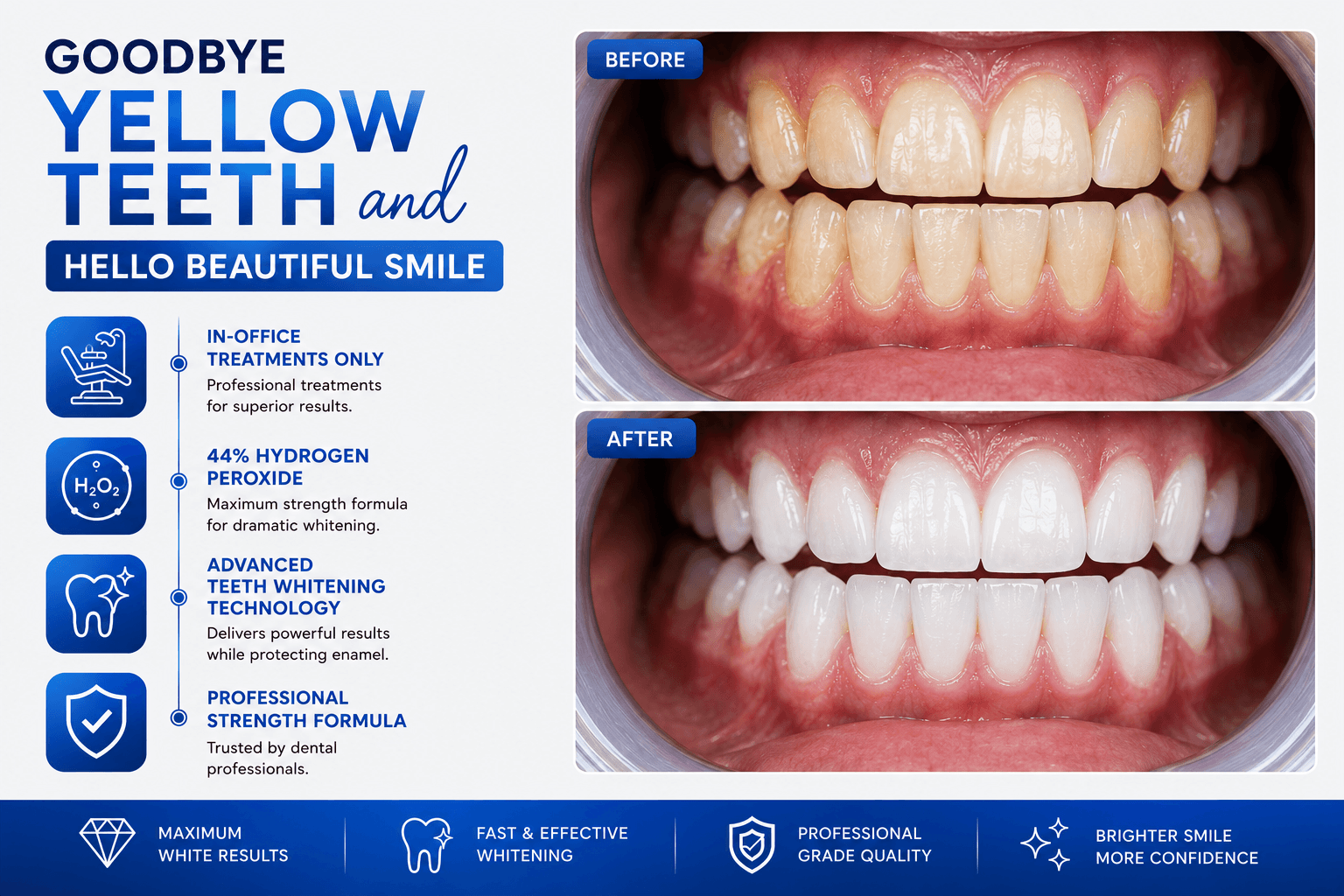 Professional teeth whitening before and after results using LaserGlow 44% hydrogen peroxide gel for in-office whitening treatments