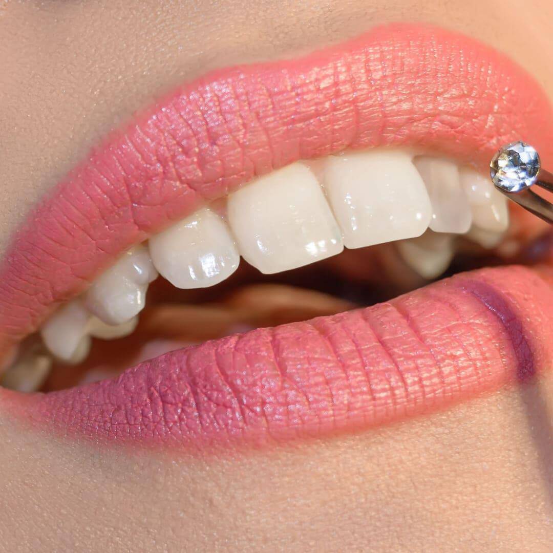 A radiant smile featuring LaserGlow Swarovski Tooth Gems, perfect for a glamorous look.