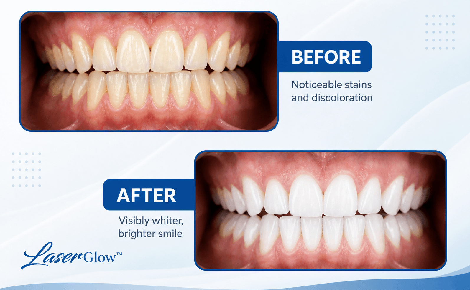 Before and after teeth whitening results showing brighter teeth after using a carbamide peroxide whitening pen