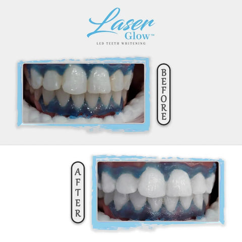 laserglow teeth whitening gel 16 hydrogen peroixde