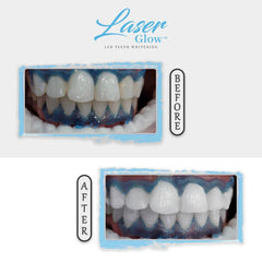 laserglow teeth whitening gingival barrier